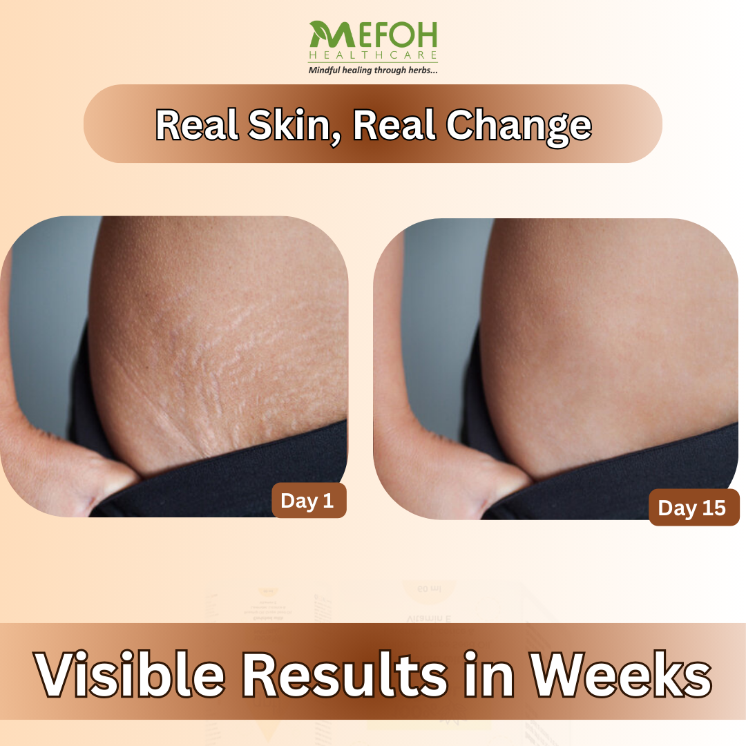 Mefoh Anti-Stretch Marks Oil – Nourishing & Repairing Oil for Smoother, Firmer Skin