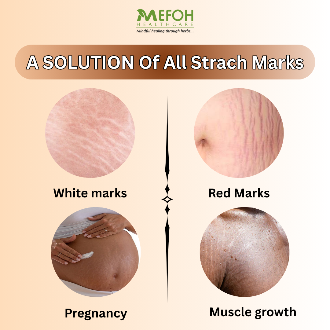 Mefoh Anti-Stretch Marks Oil – Nourishing & Repairing Oil for Smoother, Firmer Skin
